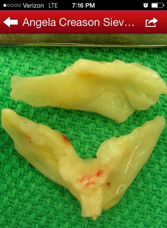 aortic valve removed after heart surger